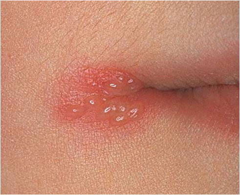 Herpes Pictures - Herpes & Cold Sores Support Network