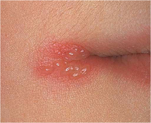 herpetic blisters #10